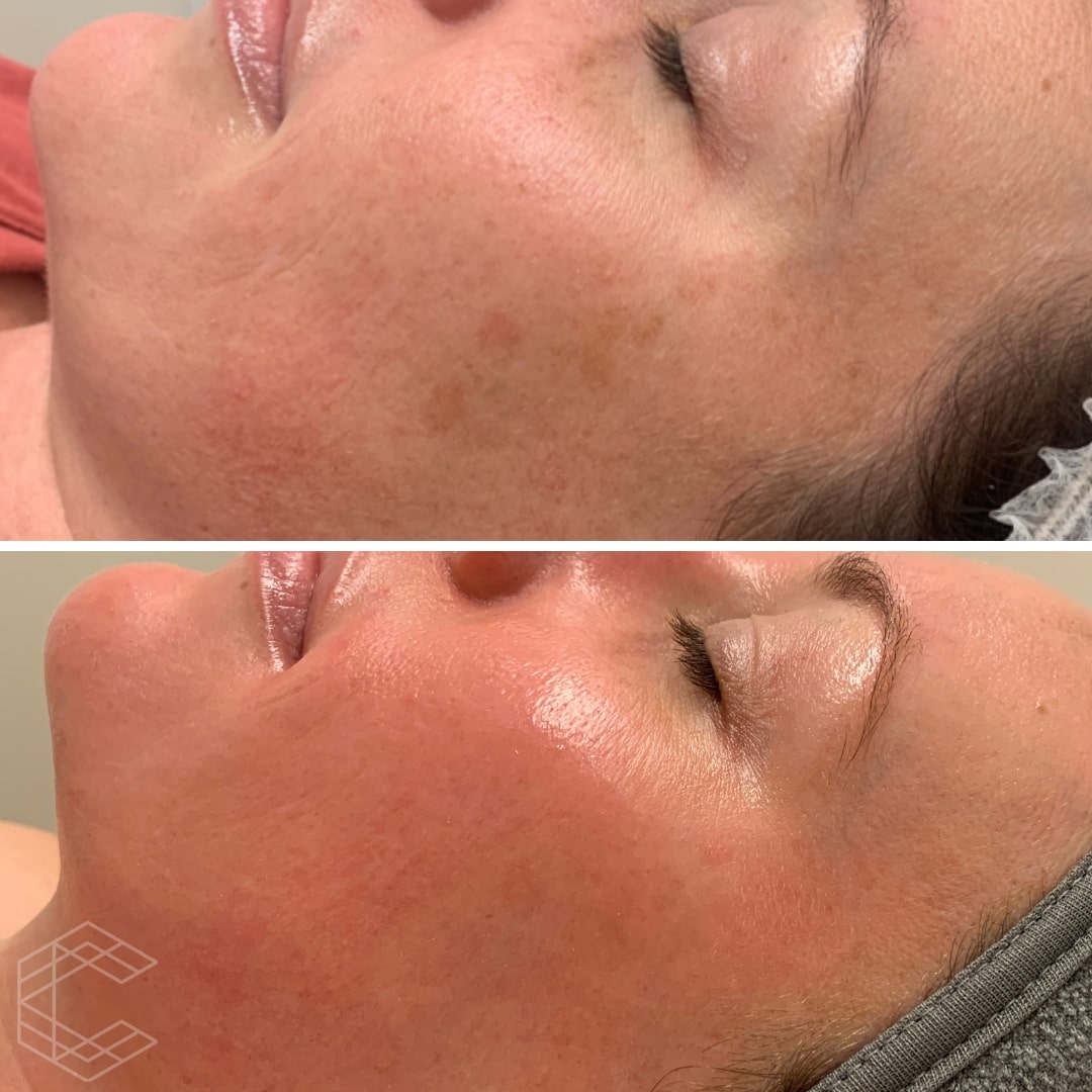 cosmelan-1-month-post-ashgrove.jpg cosmelan-1-month-post-ashgrove.jpg